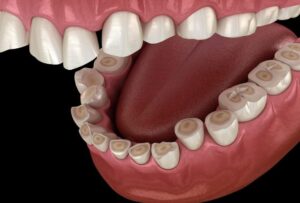 Easy Tips to Prevent Tooth Erosion and Protect Your Smile!