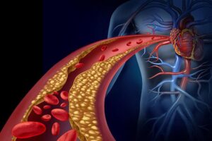Top Strategies to Minimize Your Heart Disease Risk Today
