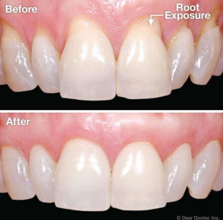 Friendly Tips for Managing Gum Recession Effectively