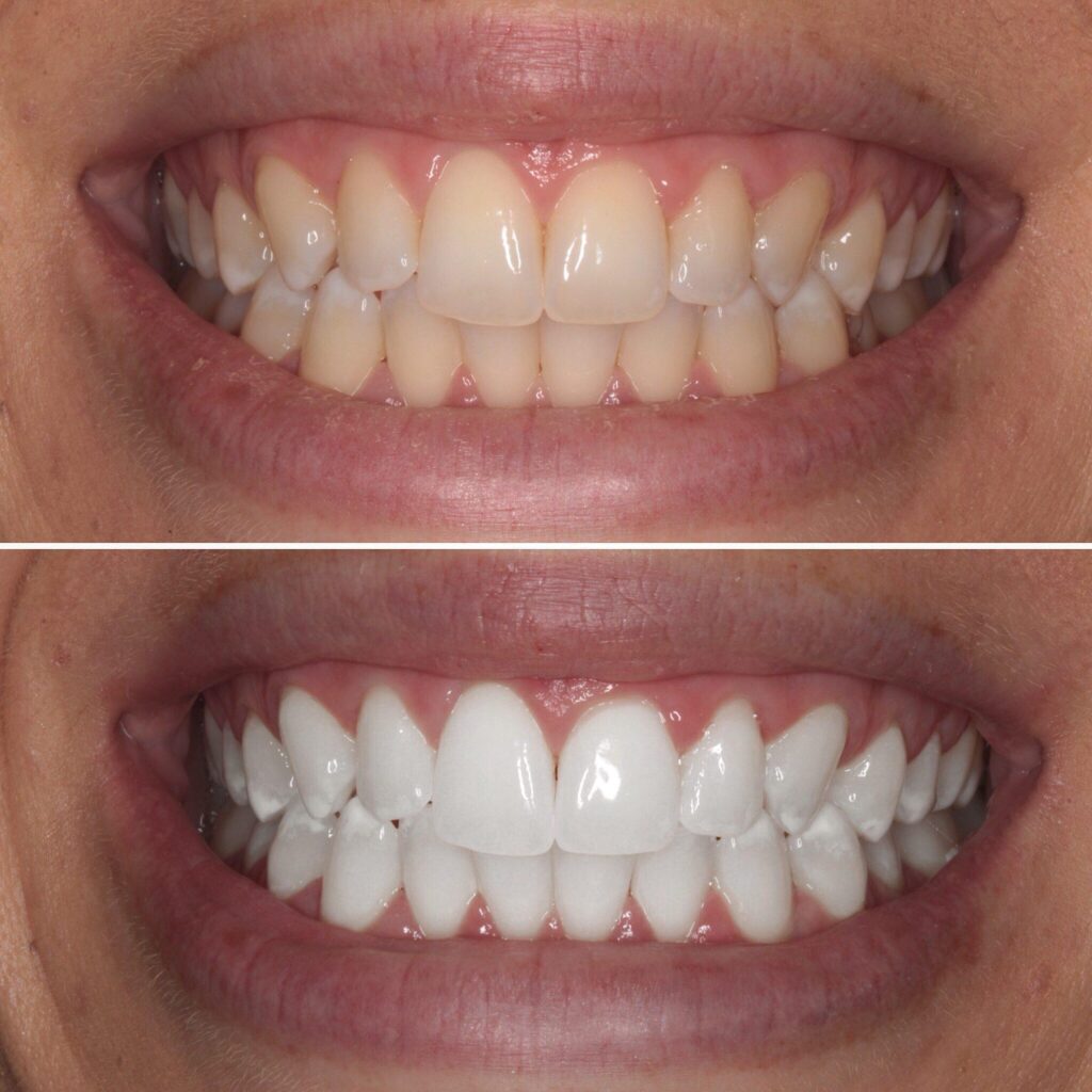 Teeth Whitening Unveiled: Essential Facts You Should Know!