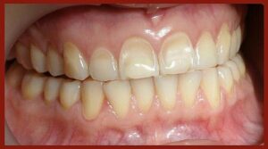 Smile Bright: Easy Tips to Prevent Tooth Erosion!