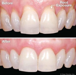 Friendly Tips to Tackle Gum Recession with Confidence!