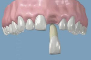 What to Do If You Knock Out a Tooth: A Friendly Guide