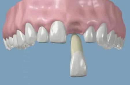 What to Do If You Knock Out a Tooth: A Friendly Guide