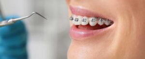 Your Guide to Post-Braces Dental Care: Keep That Smile Bright!