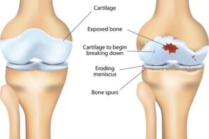 Essential Tips for Safeguarding Joints and Bones as You Age