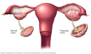Understanding PCOS: A Heartfelt Guide for Every Woman