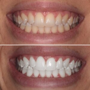 Unveiling Teeth Whitening: Your Friendly Guide to Bright Smiles!