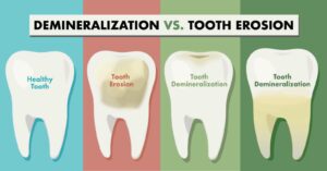 Keep Your Smile Strong: Tips to Prevent Tooth Erosion