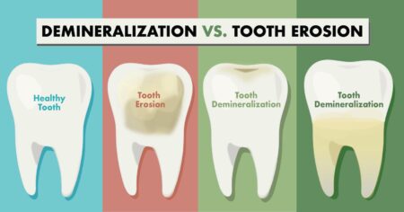 Keep Your Smile Strong: Tips to Prevent Tooth Erosion