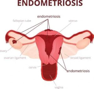 Living with Endometriosis: Finding Hope and Healing
