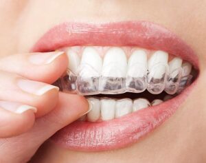 Teeth Whitening Uncovered: Facts You Can’t Ignore!