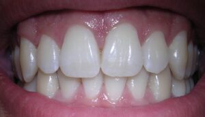 Simple Tips to Keep Your Teeth Strong and Erosion-Free!