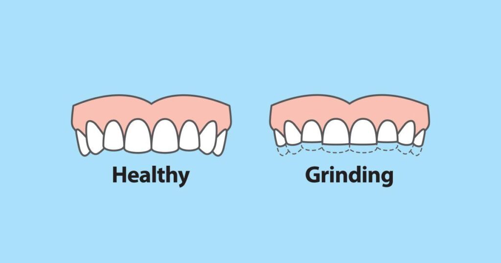 Easy Tips to Keep Your Teeth Safe from Grinding Woes!